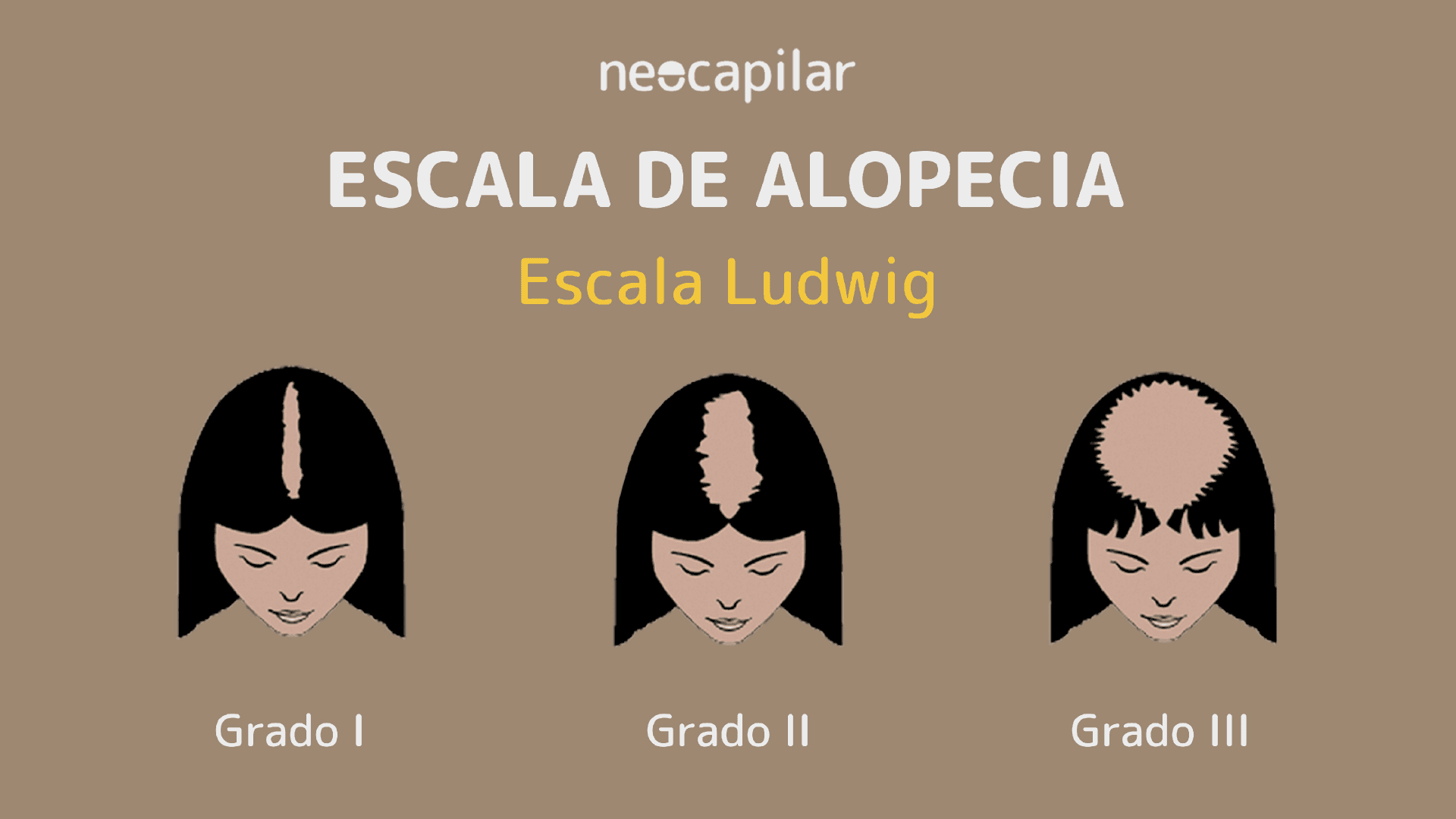 Escala de Ludwig: entiende la clasificación de la alopecia femenina y sus grados