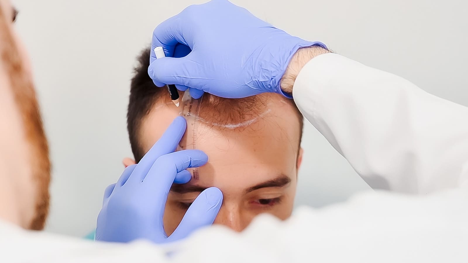 Injerto capilar sin rapar: la técnica más discreta para recuperar tu cabello