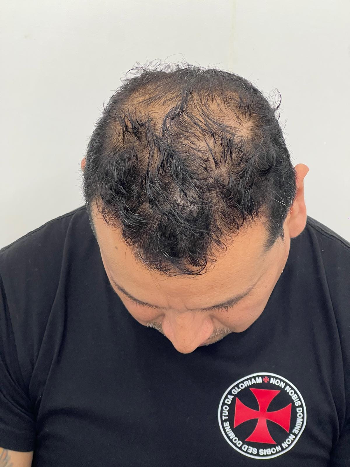 neocapilar paciente 01